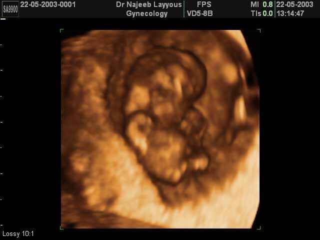 9 Weeks Fetus