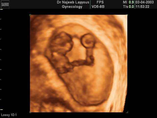 9 Weeks Fetus