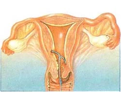 abnormal-iucd-position