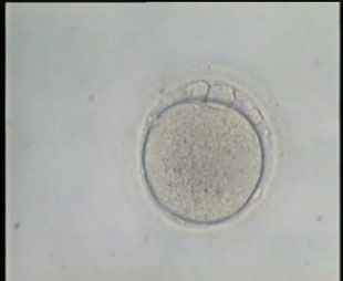 Abnormal Oocyte with Multiple Polar bodies