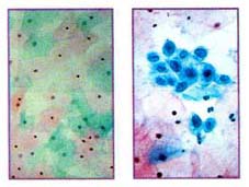 Abnormal PAP smear