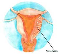 Adenomyosis