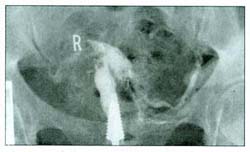 Asherman Syndrome