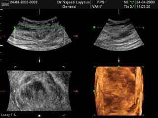 Normal Breast Tissue