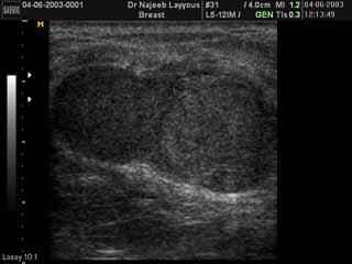 Breast Fibroadenotic Cyst