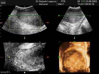 Breast Fibroadenotic Cyst 3D