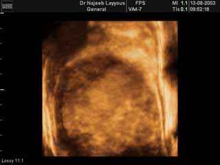 Breast Fibroadenotic Cyst 3D