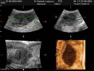 Breast Fibroadenotic Cyst 3D