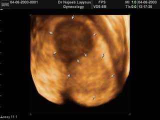 Breast Fibroadenotic Cyst