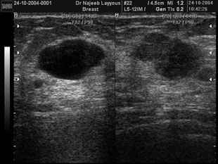 Breast Fibroadenotic Cyst and Fibroadenoma