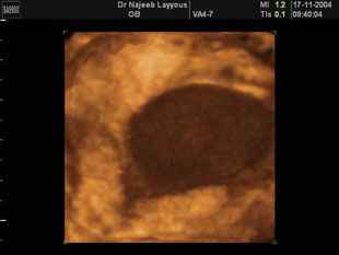 Breast Fibroadenotic Cyst 3D