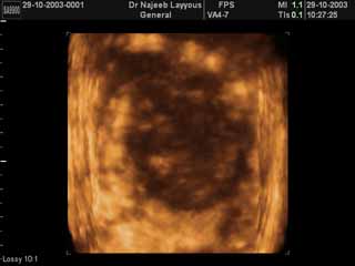 Malignant Phylloides Tumour,Fibrosarcomatous Type