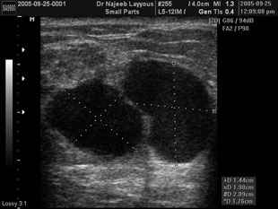 Breast Fibroadenotic Cyst