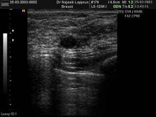 Breast Fibroadenotic Cyst