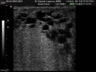 Breast Tissue In Lactating Woman