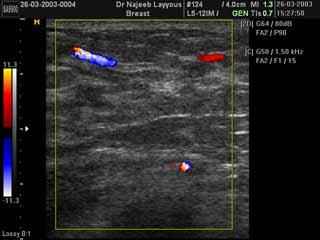 Breast Tissue In Lactating Woman With Doppler