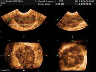 Breast Fibroadenoma