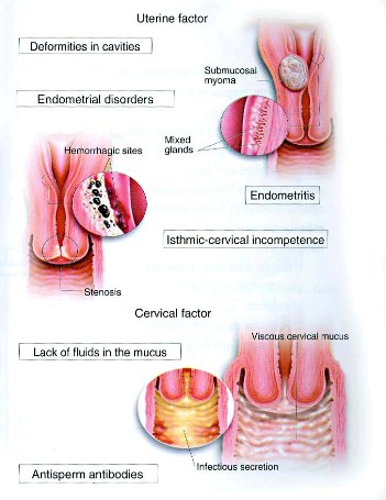 Causes of Infertility in Women