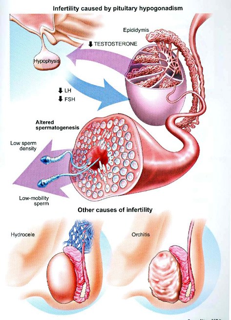 Causes of male infertility