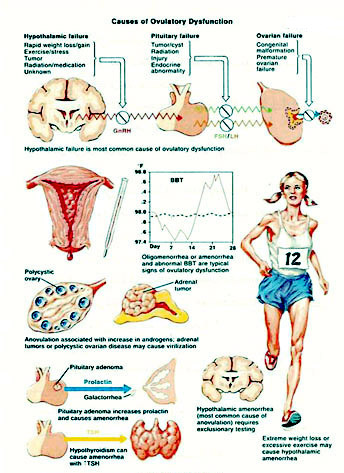Causes of Ovulatory Dysfunction