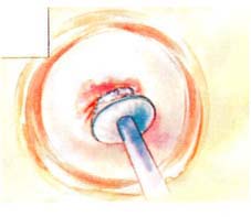 Cervical biopsy