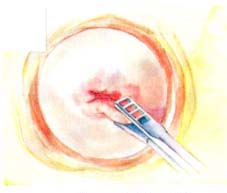 Cervical biopsy