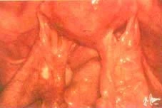 chronic-pelvis-infection