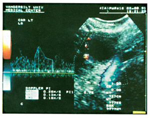 Color Doppler ultrasound