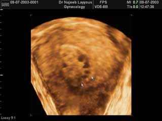 Cystic endometrial hyperplasia