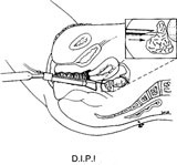 Direct Intra-peritoneal Insemination