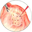 Drilling Of PolyCystic Ovary