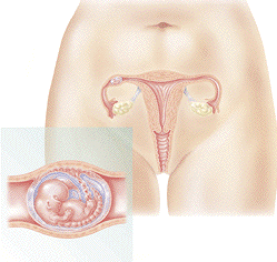 Ectopic pregnancy