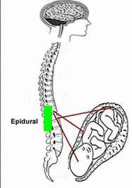 Effect of epidural on labor and delivery