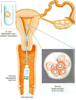 Embryo transfer