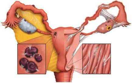 Endometriosis