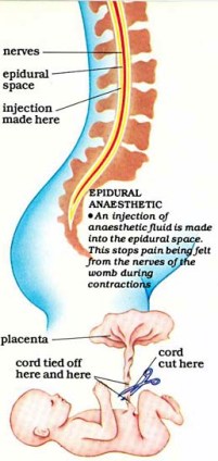 Epidural Analgesia In Labour