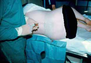 Epidural Procedure carried out by Dr. Najeeb Layyous in 1982