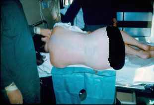 Epidural Procedure carried out by Dr. Najeeb Layyous in 1982