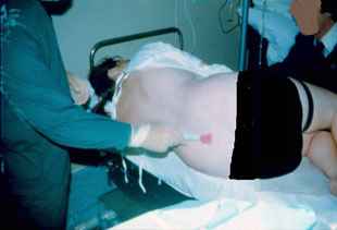 Epidural Procedure carried out by Dr. Najeeb Layyous in 1982