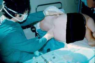 Epidural Procedure carried out by Dr. Najeeb Layyous in 1982