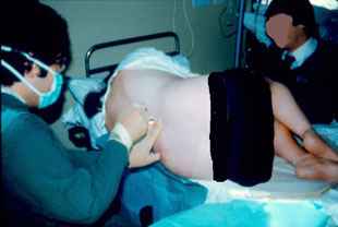 Epidural Procedure carried out by Dr. Najeeb Layyous in 1982