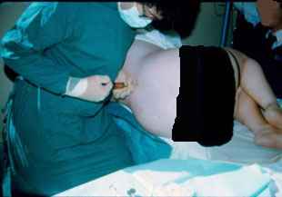 Epidural Procedure carried out by Dr. Najeeb Layyous in 1982