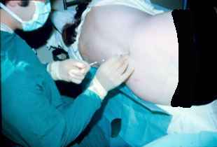 Epidural Procedure carried out by Dr. Najeeb Layyous in 1982