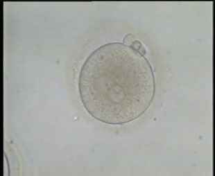 Fertilized Oocyte with clear two Pronuclei and 2nd polar body