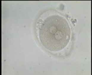 Fertilized Oocyte with abnormal wide perivitelline space