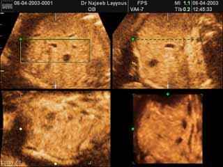 Fetal Liver