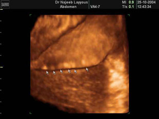 Gallbladder Stones