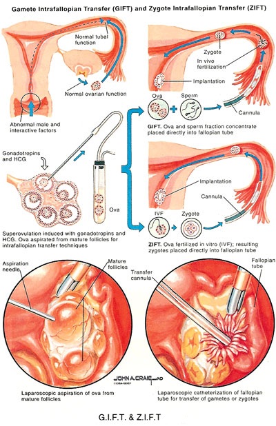 Gamete and zygote Intra-Fallopian Transfer