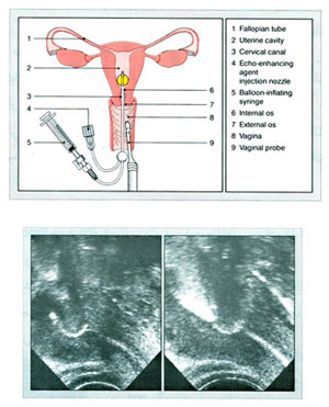 Hysterosalpingo Contrast Sonography