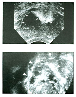 Hysterosalpingo Contrast Sonography